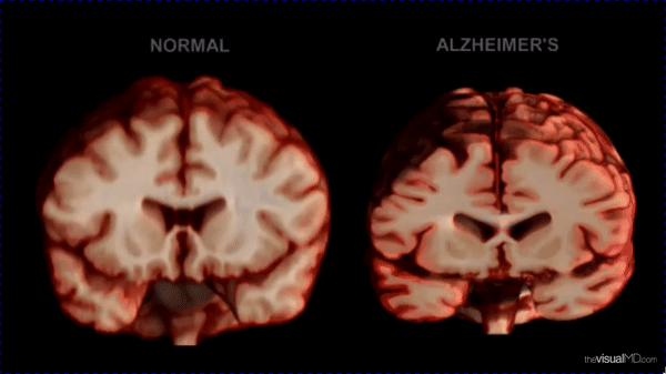 Understanding Alzheimer’s: Causes, Symptoms, and Diagnosis